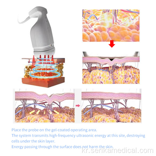 휴대용 Liposonix 질 강화 기계